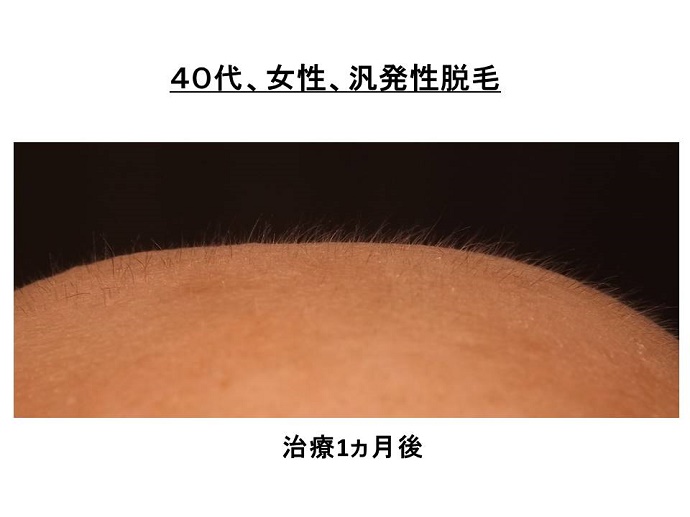 円形脱毛症　病院""